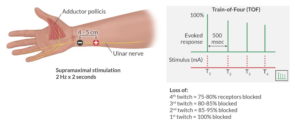 Using Train-of-Four monitoring with supramaximal stimulation