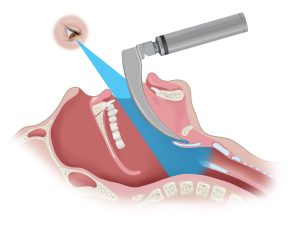 a direct laryngoscope in use