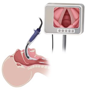 a video laryngoscope in use