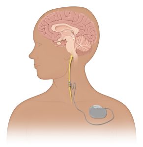 Medical drawing showing human brain that has a lead attached to an exposed vagus nerve and a VNS generator in the anterior left chest. 