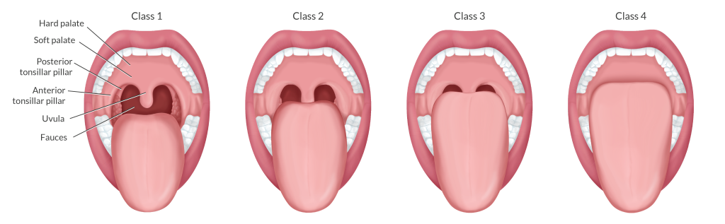 illustrations of class 1-4 of the soft palate