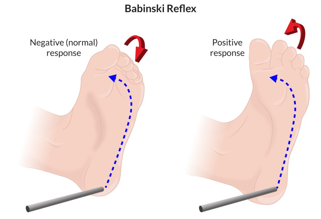 the babinski reflex, showing negative and positve responses